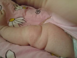 Аллергия от порошка на ноге у новорожденного, фото
