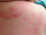 как выглядит аллергия у ребенка фото