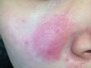 Фотография аллергии от холода на щеке, фото