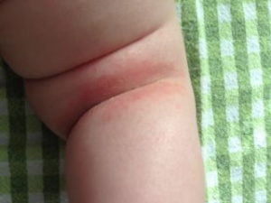Аллергия на ноге у ребенка, фото