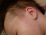 Потница на лице у ребенка, фото