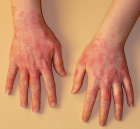 аллергия на руках: как остановить распространение?
