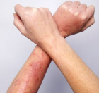 аллергическая сыпь на руках