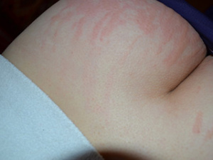 Аллергия на попе у ребенка, фото
