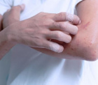 аллергическая экзема: почему появляется и как бороться