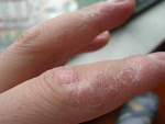 Нейродермит на пальцах рук, фото