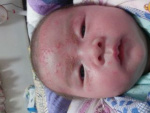 Аллергия на лице у новорожденного, фото