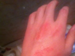 Аллергия на руке, фото