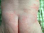 Аллергия на попе у ребенка, фотография, фото
