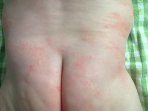 Аллергия на попе у ребенка, фотография, фото