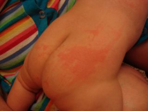 Аллергия на попе у ребенка от стирального порошка, фото
