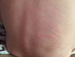 Аллергия на спине у ребенка, фото