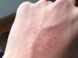 Аллергия от порошка на руке, фото