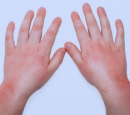 контактный дерматит на руках