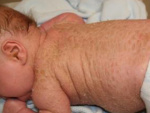 Ихтиоз у грудного ребенка, фото