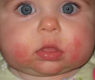 диатез у детей – почему у малыша красные щёчки?