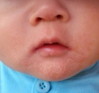 раздражение кожи вокруг рта у ребёнка: что случилось с малышом?