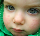 что такое аллергия крапивница?