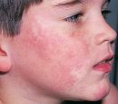 атопический дерматит на лице и голове