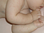 симптомы аллергии у ребенка - фото