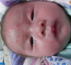 аллергия на лице у ребёнка