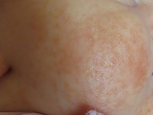 Диатез у новорожденного на щеках, фото