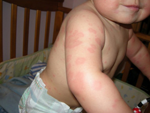 Фотография кожной аллергии у ребенка, фото