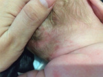 Потница на голове у грудного ребенка, фото