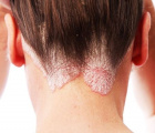 дерматит кожи головы: лоб и волосистая часть