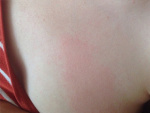 Аллергический дерматит на теле, фото