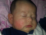 Диатез у грудного ребенка на лице, фото
