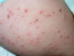 Фотография аллергии на теле у ребенка, фото