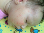 Аллергия на порошок на щеках у ребенка, фото