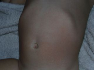 Аллергия на животе у ребенка от порошка, фото