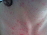Аллергия на теле от холода у взрослого , фото
