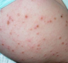 лечение аллергии на коже