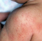 атопический дерматит у детей и взрослых