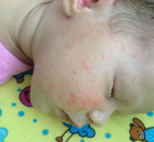  аллергия на щеках у детей