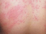 Аллергия на спине в взрослого, фото