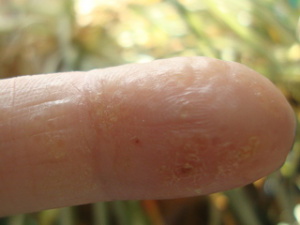 Дисгитротическая экзема пальцев , фото