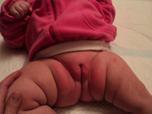 Опрелости у грудного ребенка в промежности, фото