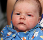 аллергический дерматит у новорождённых