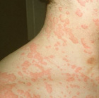 аллергия: красные пятна