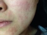 Аллергия от холода на лице, фото
