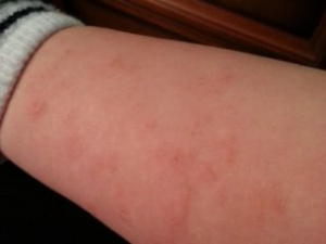 Аллергия на руке у ребенка, фото