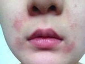 Аллергия от холода вокруг рта, фото, фото