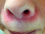 Аллергия от холода у взрослого вокруг носа, фото