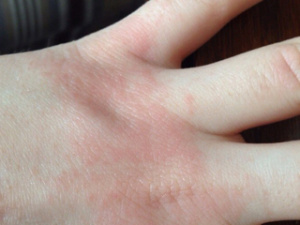 Аллергический дерматит на руке, фото